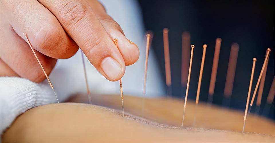 Akupunktura je vrsta tradicionalne kitajske medicine, ki se uporablja že več kot 2500 let.