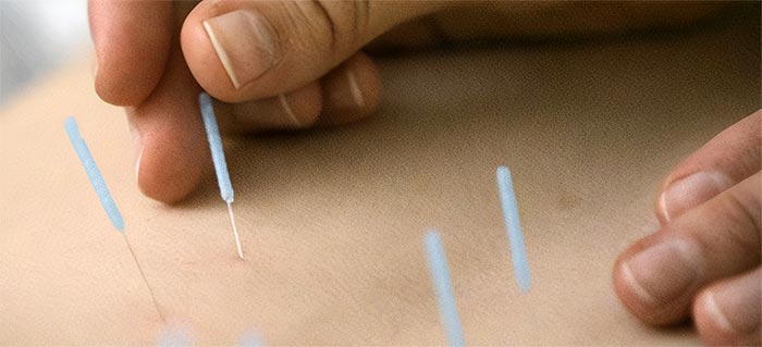 Cupping iglom kombinacija je cupping terapije i akupunkture.